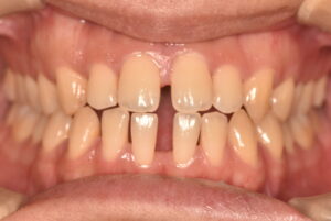 インビザライン