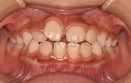 インビザラインファースト